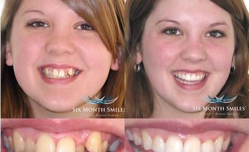 $500 OFF Six Month Smiles and FREE Whitening